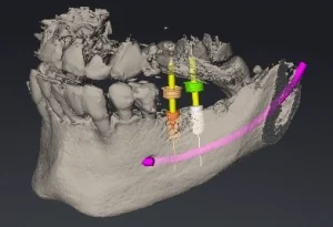 Planung eines modernen Implantats mittels 3D-Röntgen (DVT) | ZAE Bonn