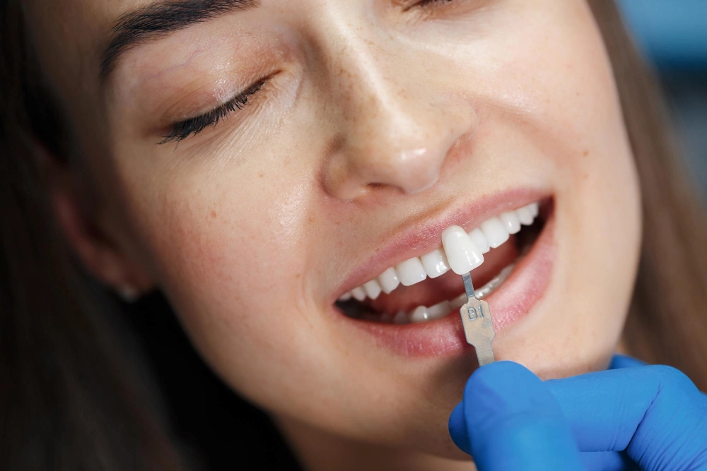 Veneers Behandlung bei ZAE Bonn