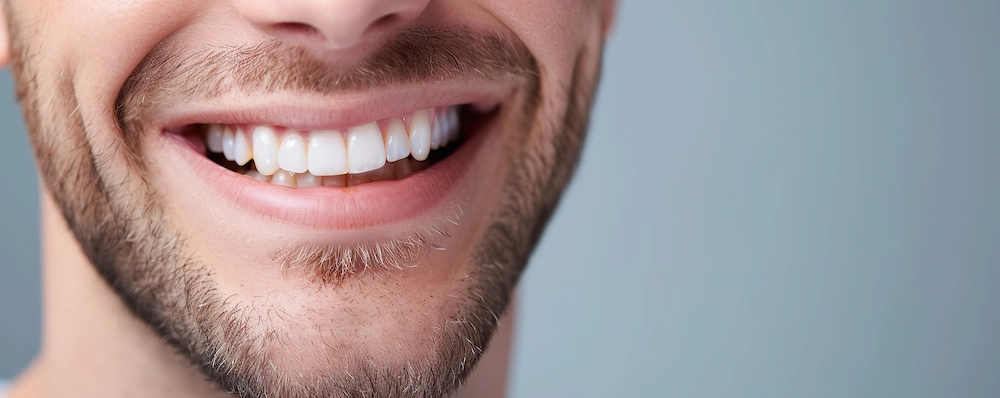 Strahlend weisse Zähne eines Mannes nach Veneers behandlung