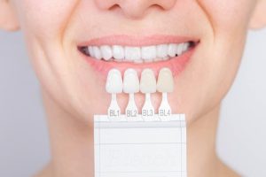 Zahnfarbskala zur Dokumentation vor und nach dem Bleaching