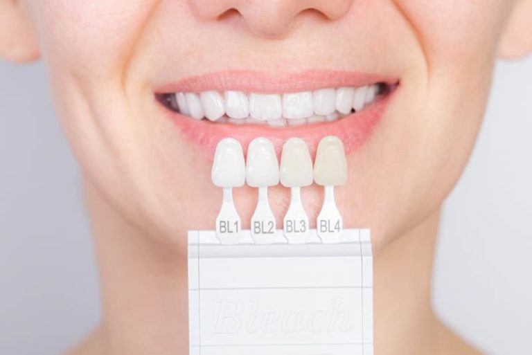 Zahnfarbskala zur Dokumentation vor und nach dem Bleaching