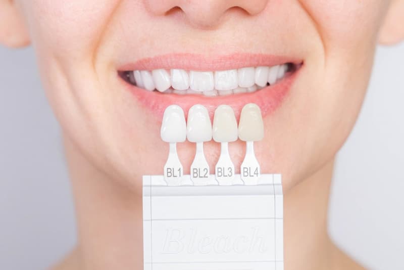 Zahnfarbskala zur Dokumentation vor und nach dem Bleaching